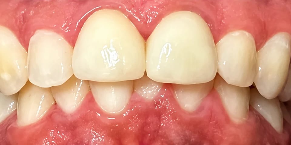 After treatment: front teeth even in shade and shape
