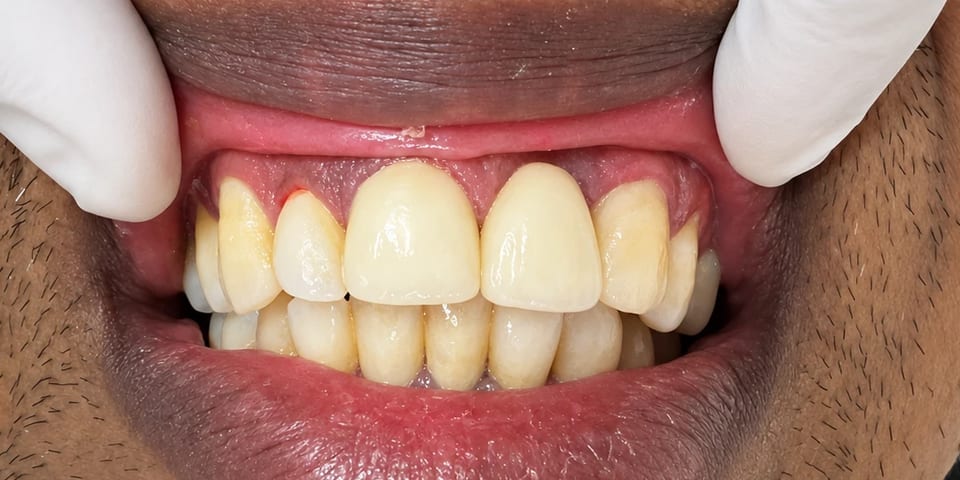 After treatment: the gap closed and the front teeth in one even line