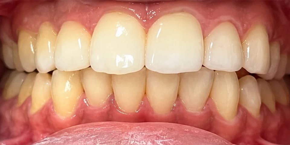 After treatment: a level, balanced row of upper teeth