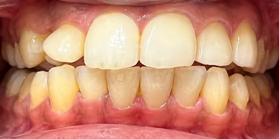 Before treatment: an out-of-line side tooth and uneven edges