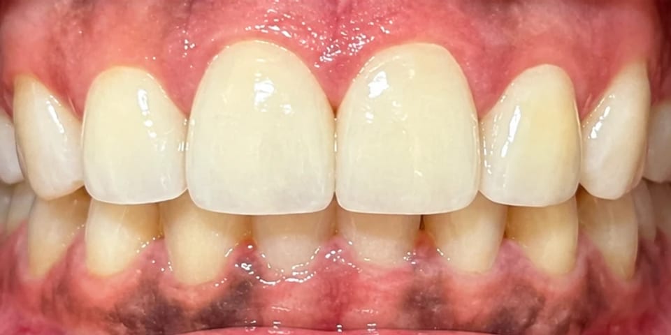 After treatment: the gaps closed with veneers
