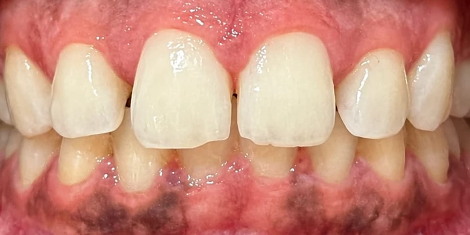 Before treatment: small gaps between the front teeth