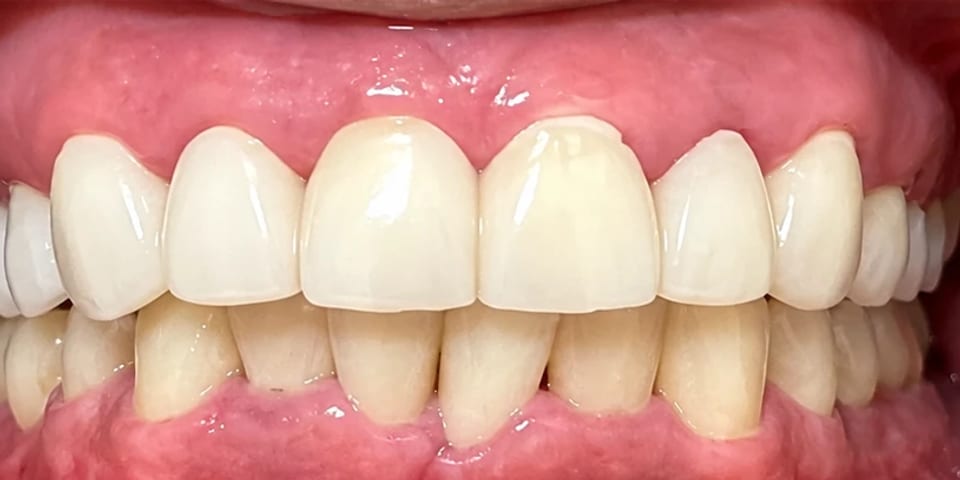 After treatment: a brighter, even upper arch