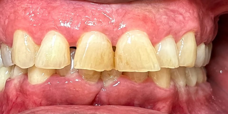 Before treatment: spaced, yellowed upper teeth