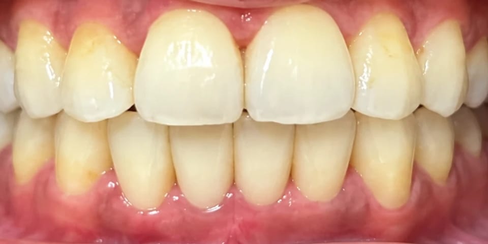 After treatment: the lower front teeth restored