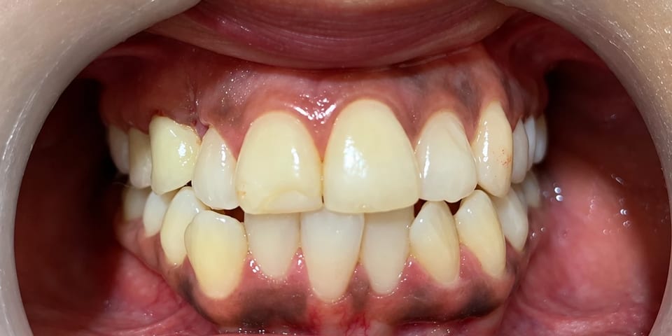 After treatment: the canine in line with the arch