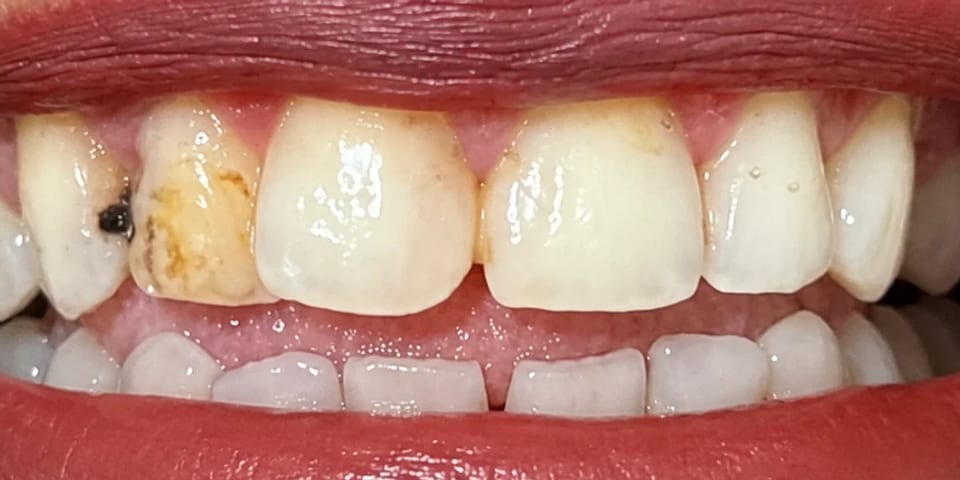 Before treatment: two stained, damaged upper teeth
