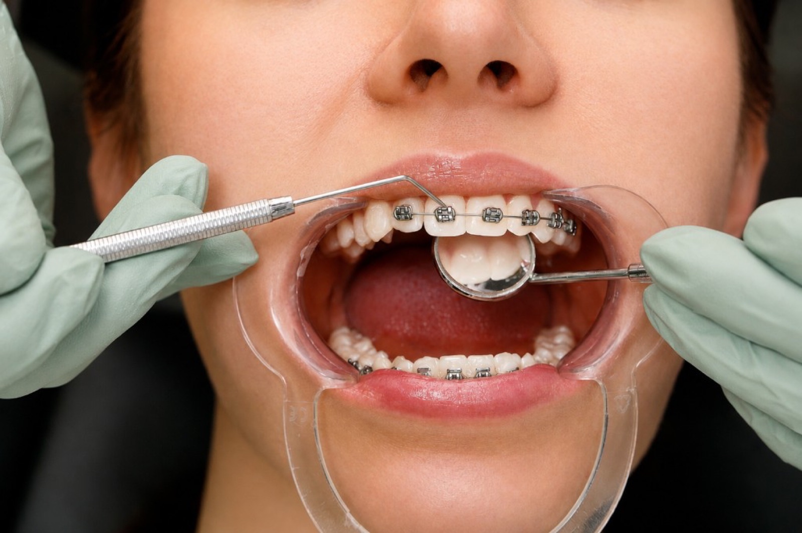 Orthodontic braces being checked in the chair