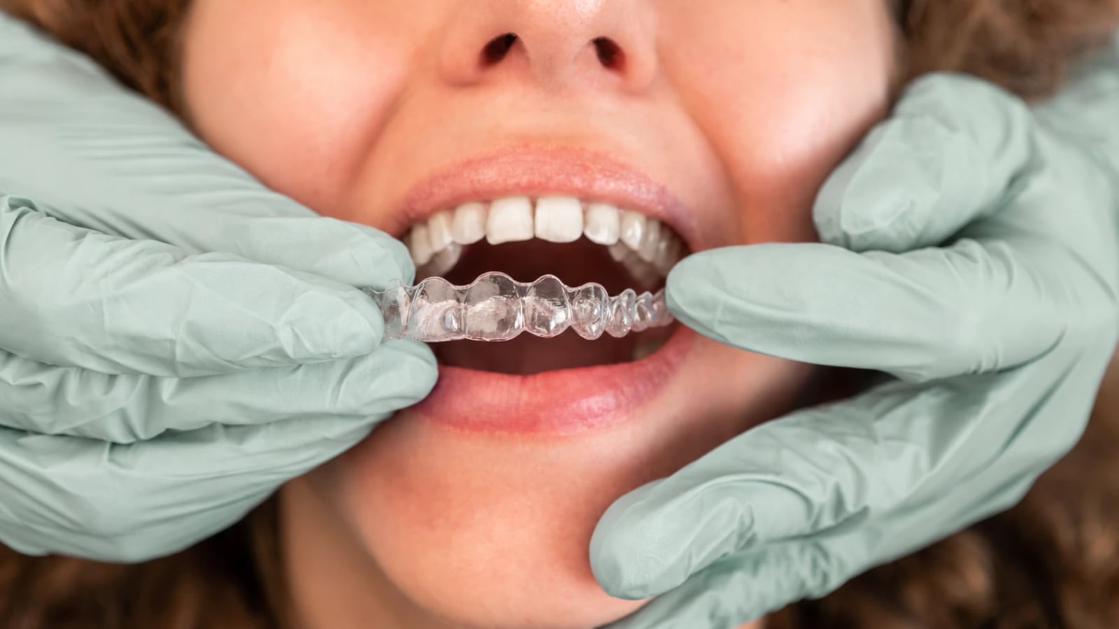 Clear aligner being placed on the teeth