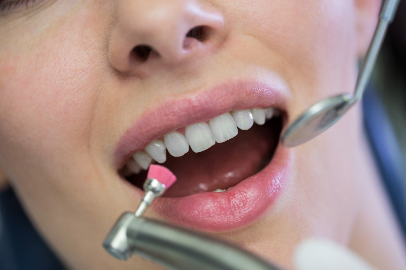 Dental polishing of a bright smile